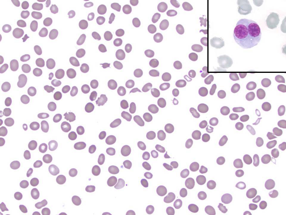 Peripheral blood smear demonstrates pancytopenia; red blood cells show significant anisopoikilocytosis with occasional red cell fragments and abnormal appearing circulating nucleated red blood cells (inset)